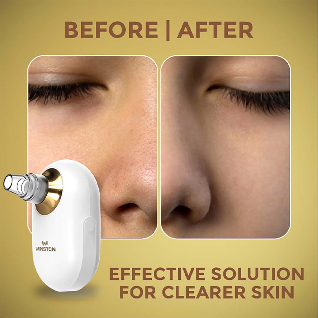 Winston Vacuum Acne Pore Cleanser/ Blackhead Remover with 3 Suction Modes & 5 Replaceable Heads