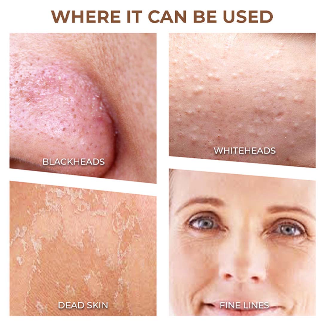 Winston Vacuum Acne Pore Cleanser/ Blackhead Remover with 3 Suction Modes & 5 Replaceable Heads