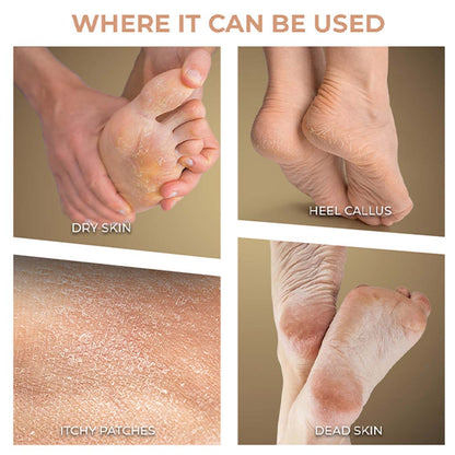 Winston Callus Remover for Healing Cracked Feet & Dead Skin Removal