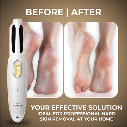 Winston Callus Remover for Healing Cracked Feet & Dead Skin Removal